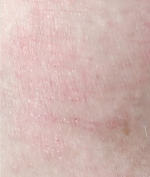 EASI erythema1